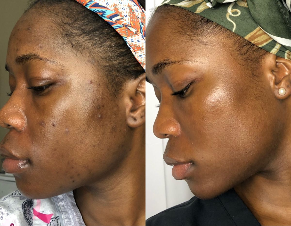 Facial result 4 by Kera's Exclusive Mobile Salon and Spa